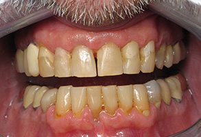 The image shows a close-up of a person s mouth with yellowed teeth and red gums, indicating poor oral hygiene or dental health issues.