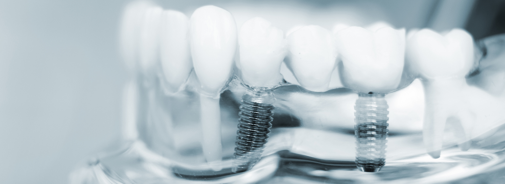 The image depicts a close-up view of a dental implant with visible screws and a transparent, plastic-like material, likely a model or prototype for educational purposes.